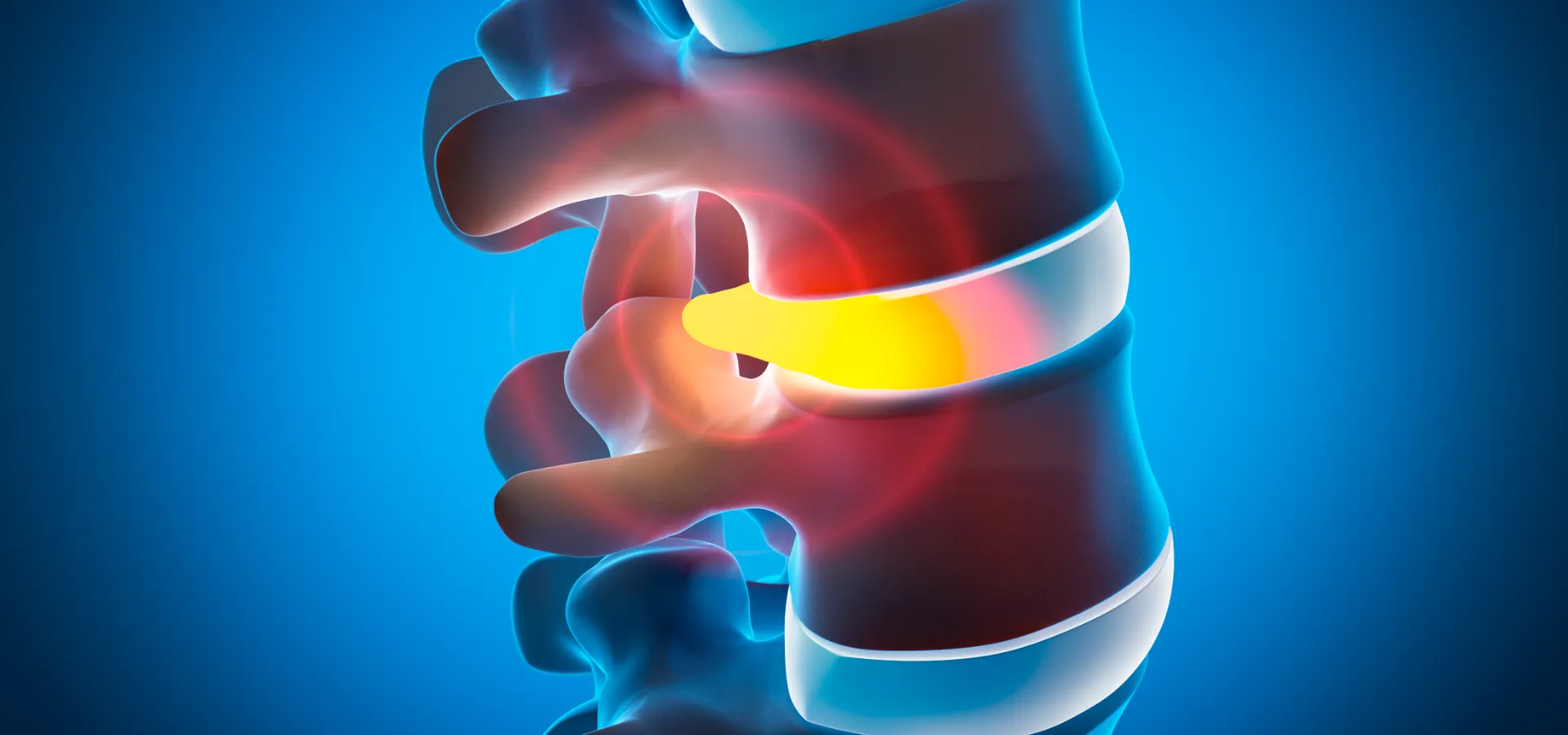 ¿Dolor de espalda o una hernia discal? Cuándo es momento de consultar a un neurocirujano